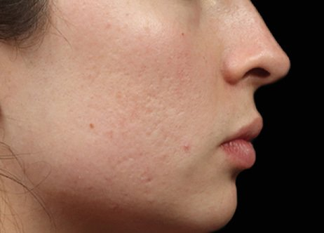 Before Exion Face