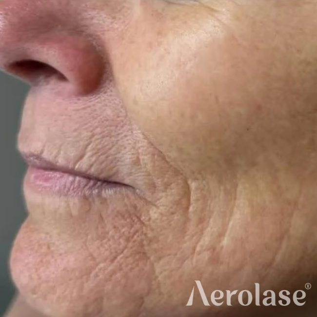Before Aerolase Neo