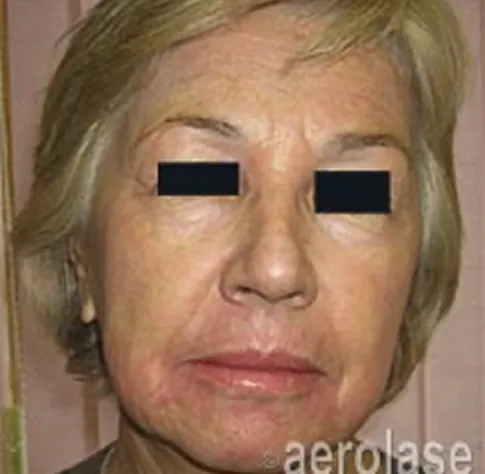 After Aerolase Era