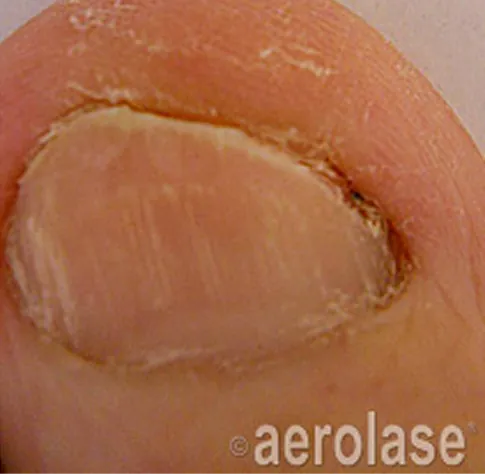After Aerolase Neo