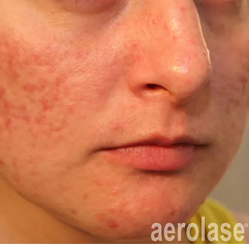 After Aerolase Neo