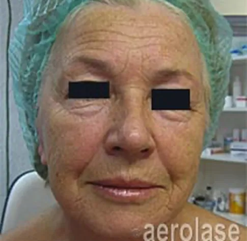 Before Aerolase Era