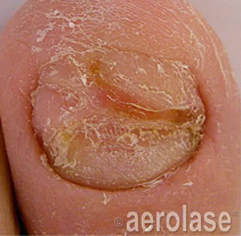 Before Aerolase Neo