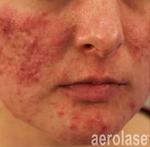 Before Aerolase Neo