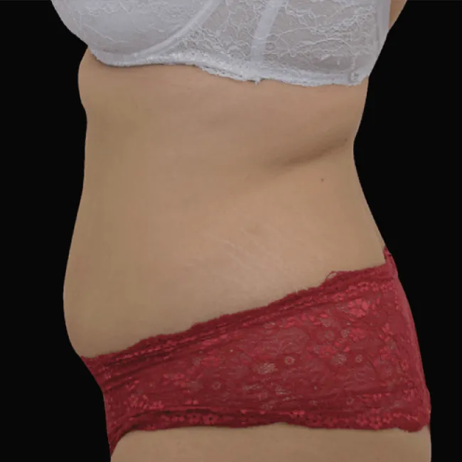 After Emsculpt Neo