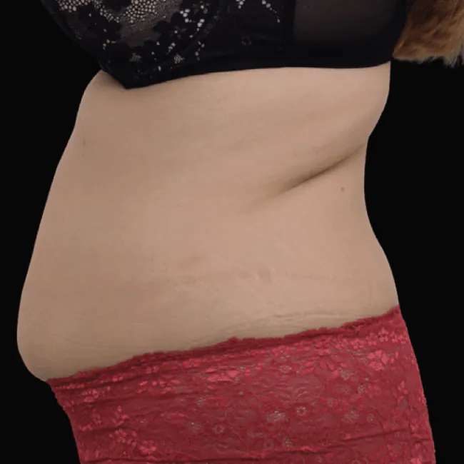 Before Emsculpt Neo