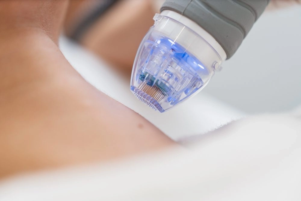 Exion RF microneedling tip with a blue light on the skin