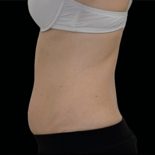 Before Exion Body