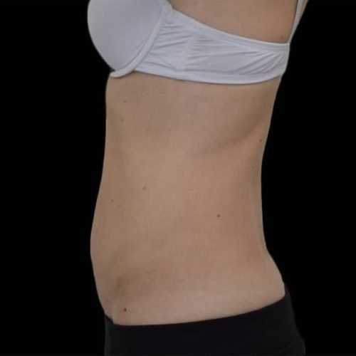 After Exion Body