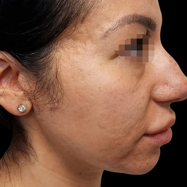 After Exion RF Microneedling