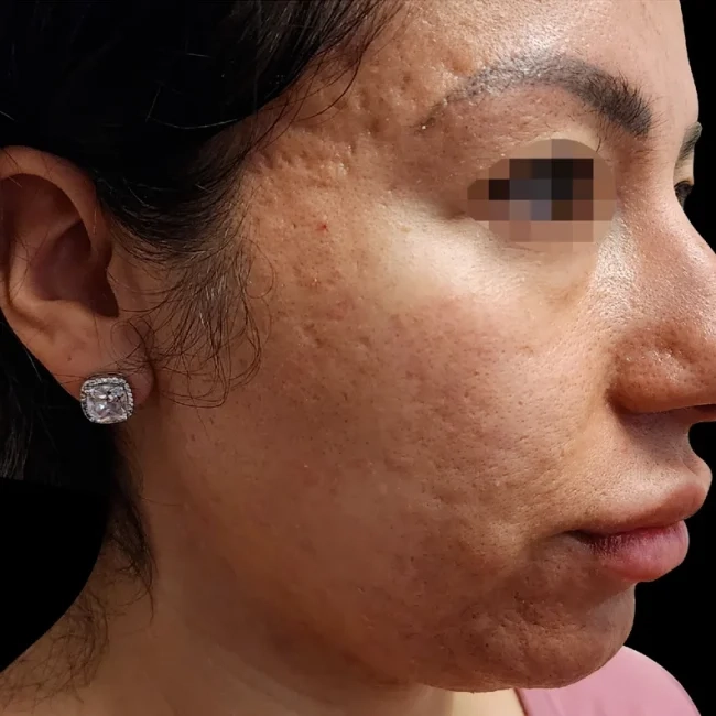Before Exion RF Microneedling
