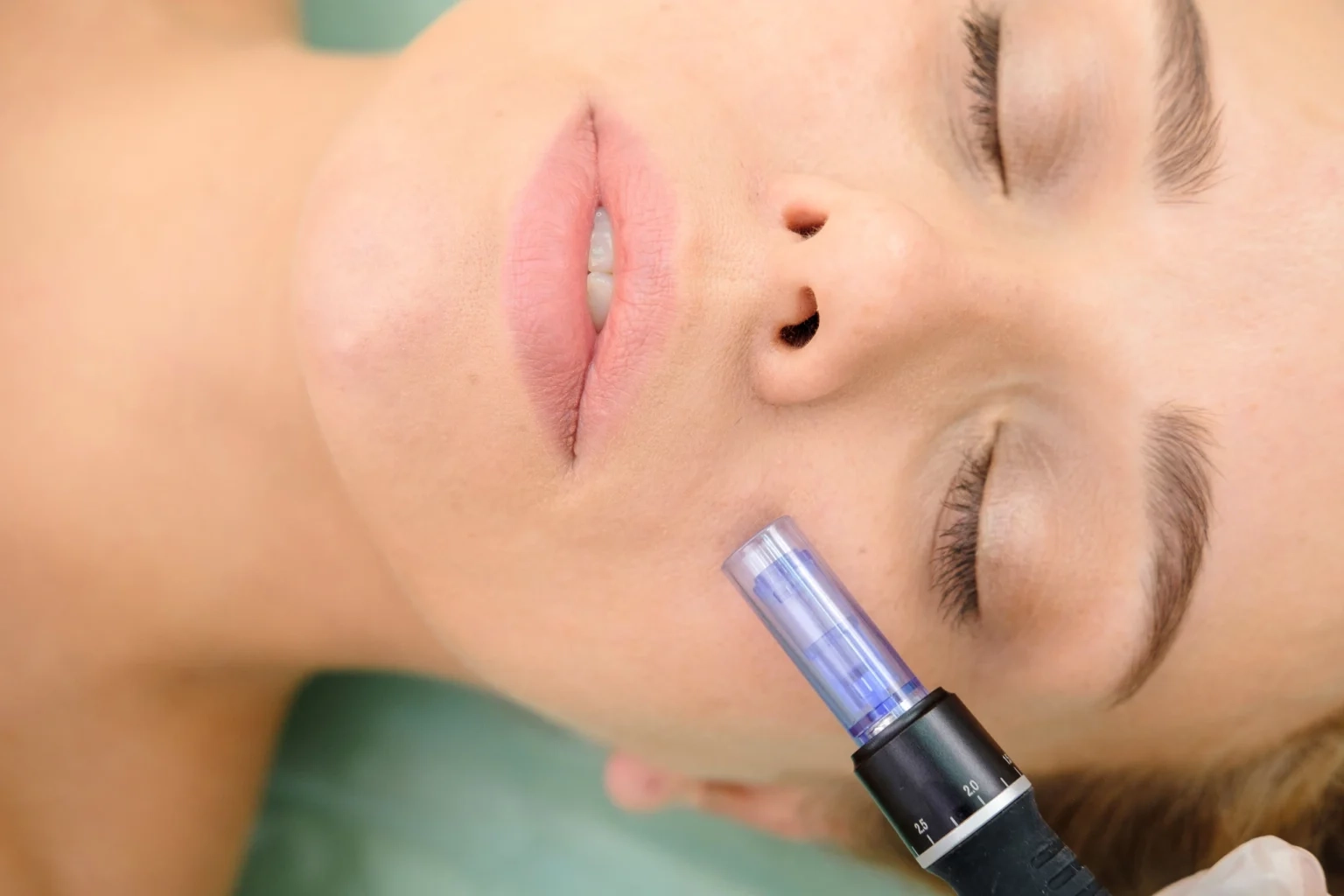 Microneedling