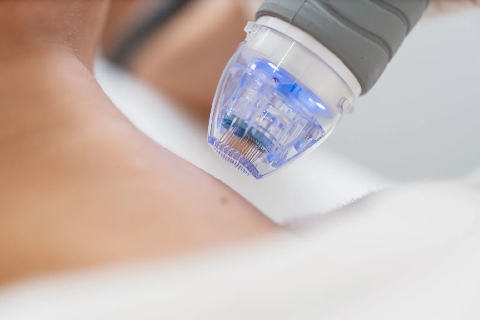 Microneedling