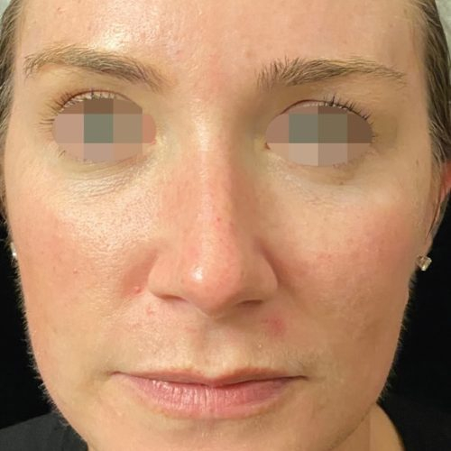 After Opus Plasma