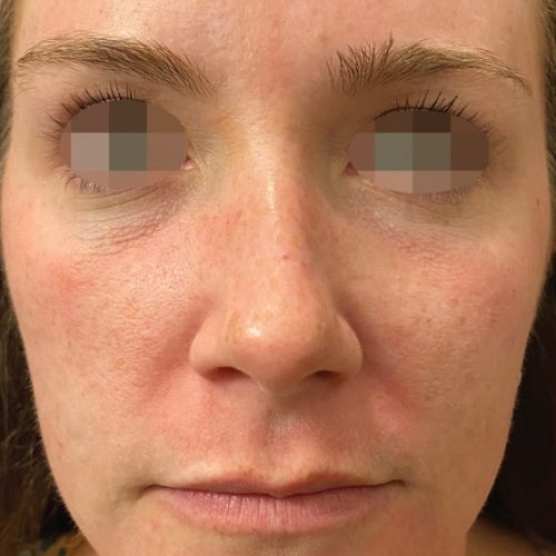 Before Opus Plasma