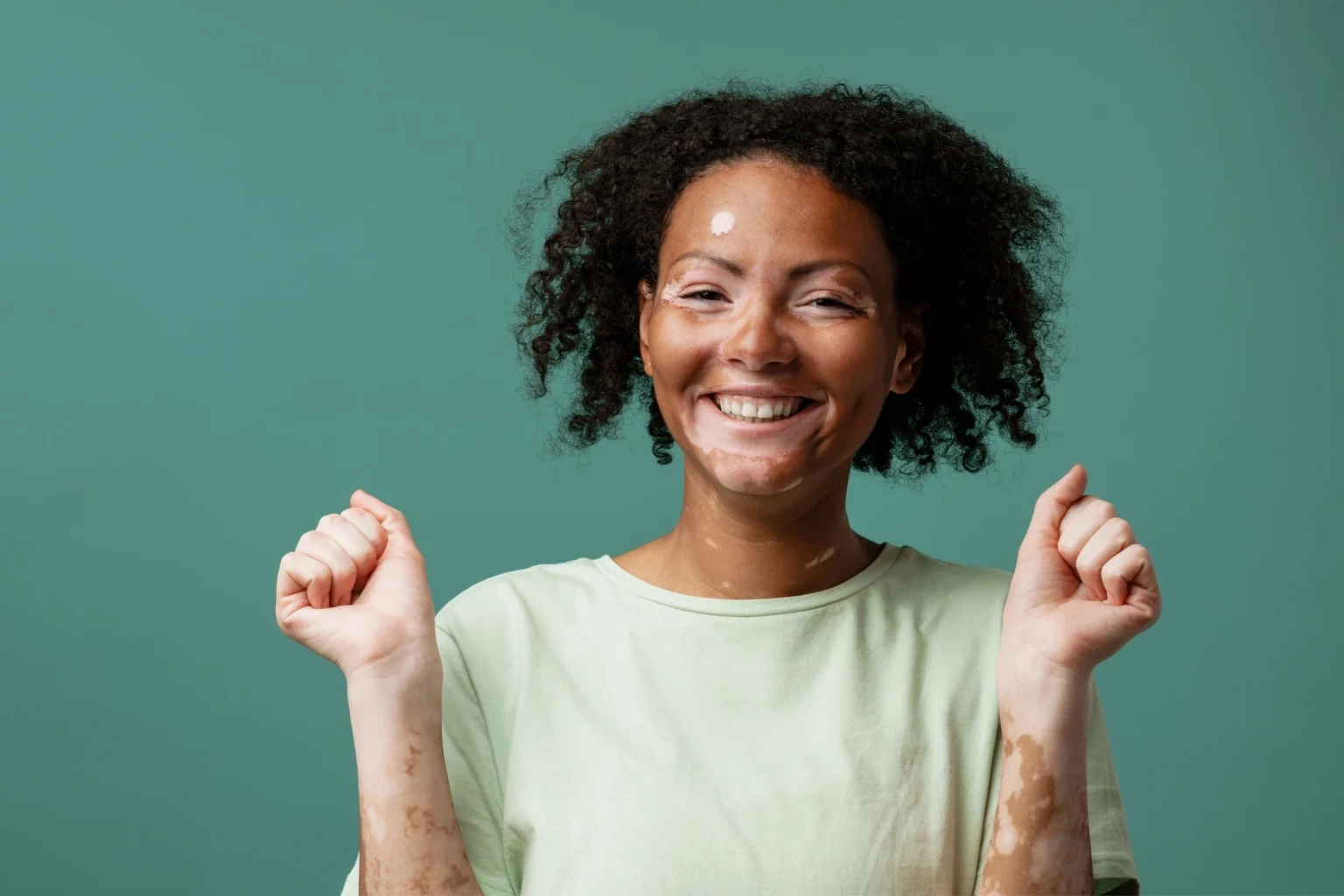 Sun Spots and Melasma