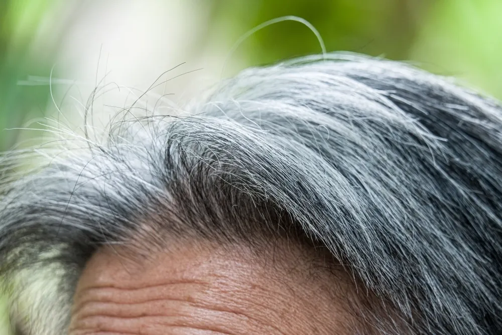 PRP and PRF for Hair Loss